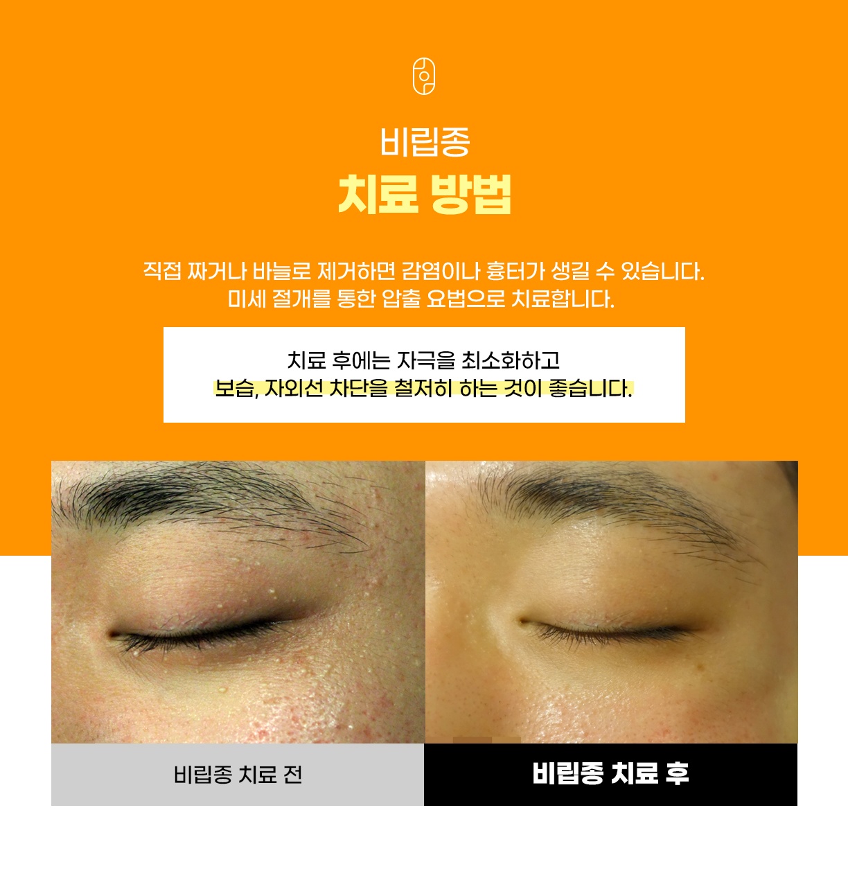 짜거나 바늘로 제거하지 않고 미세 절개 압출로 치료한 눈가 비립종 전후 사진