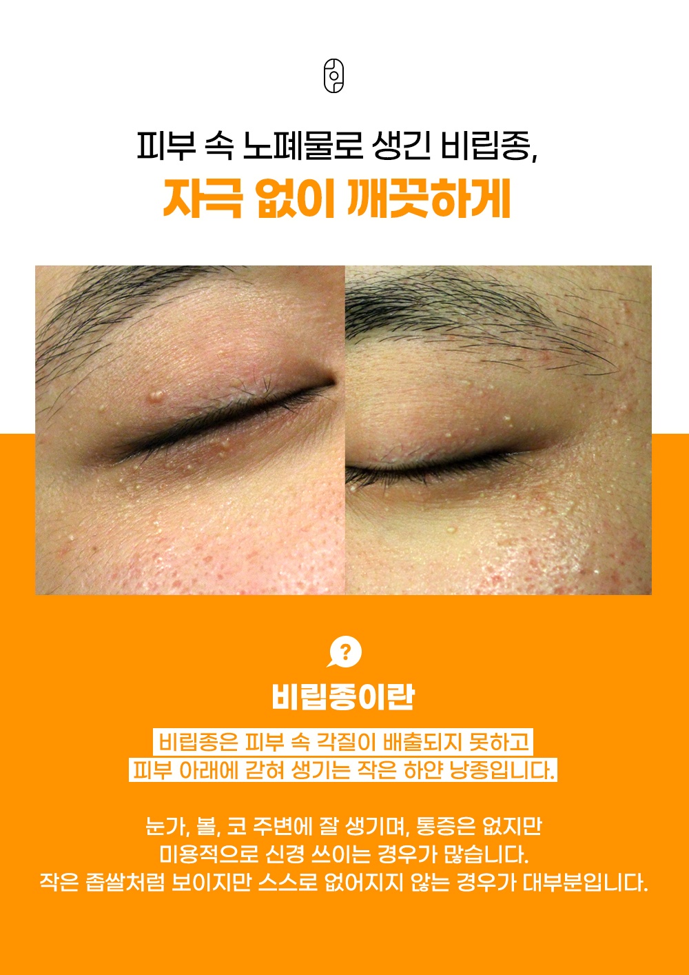 피부 속 각질이 갇혀 생기는 눈가 비립종의 모습과 정의