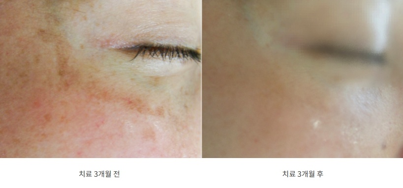 볼 바깥쪽에 띠처럼 퍼진 기미가 사라진 3개월 전후 사진