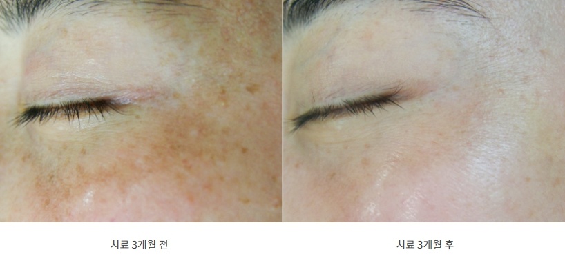 눈 밑과 광대에 번진 갈색 색소가 옅어진 3개월 전후 비교