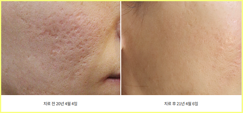 신사여드름흉터 볼 패임 흉터 치료 전후