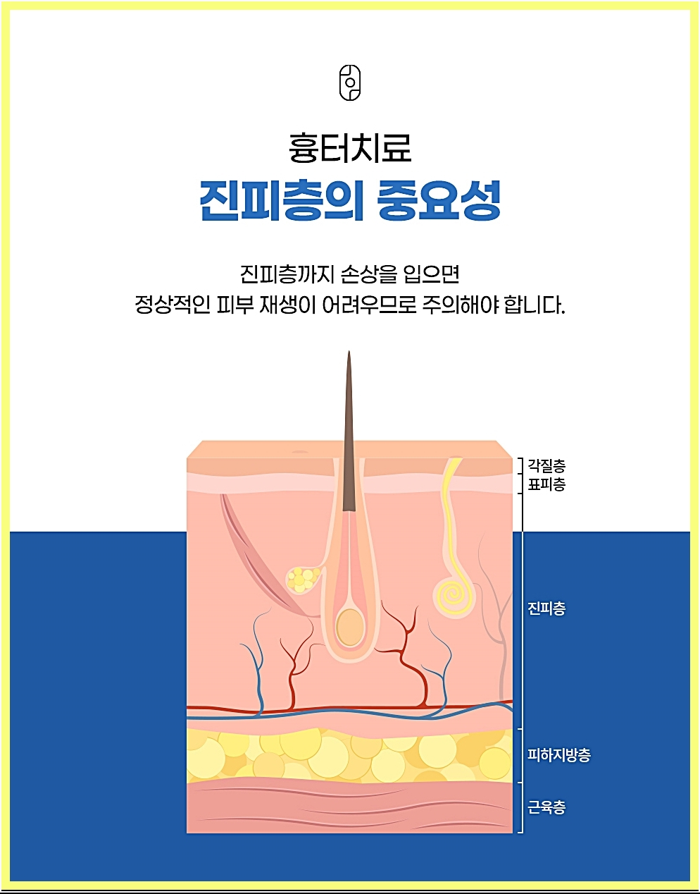 여드름흉터 치료 관련 진피층의 중요성
