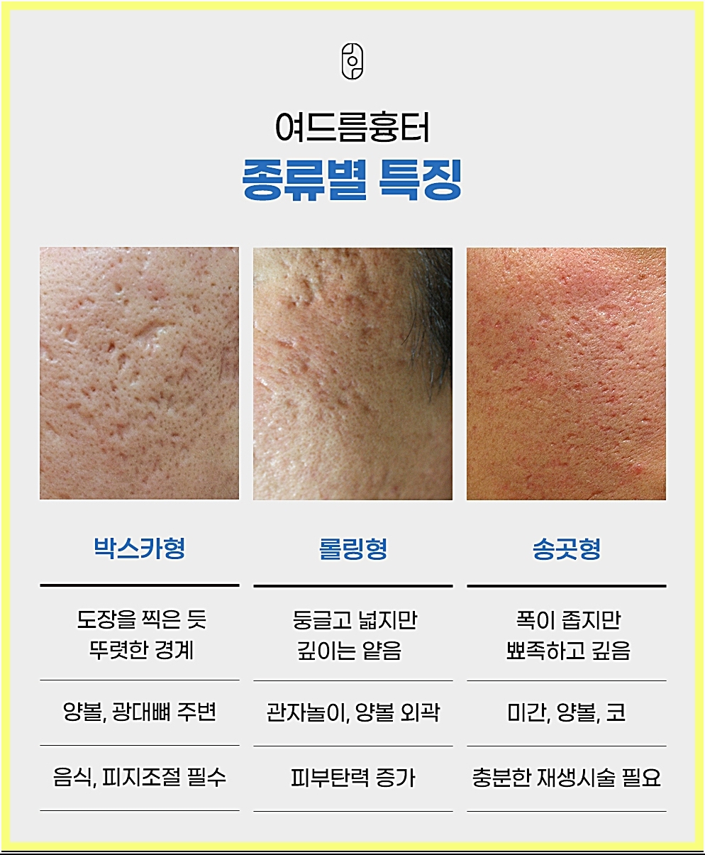 신사여드름흉터 채인 유형별 특징 설명 이미지