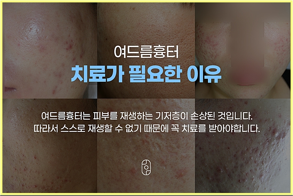 여드름흉터 자연적으로 개선되기 어려운 이유