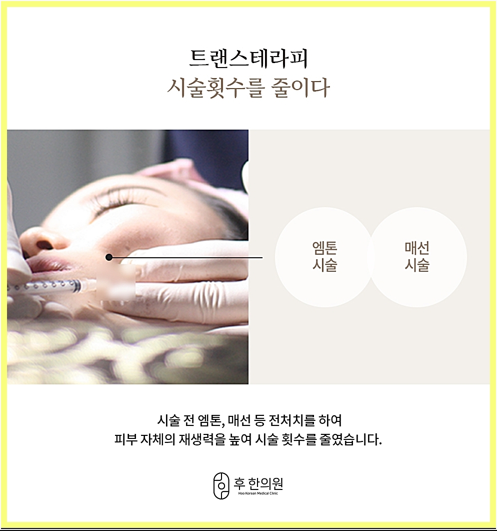신사여드름흉터 트랜스테라피 전처치