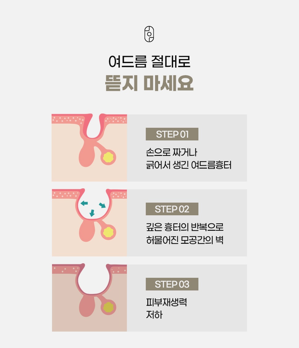 손으로 짜거나 긁으면 흉터, 모공 벽 손상, 피부재생력 저하로 이어지는 3단계