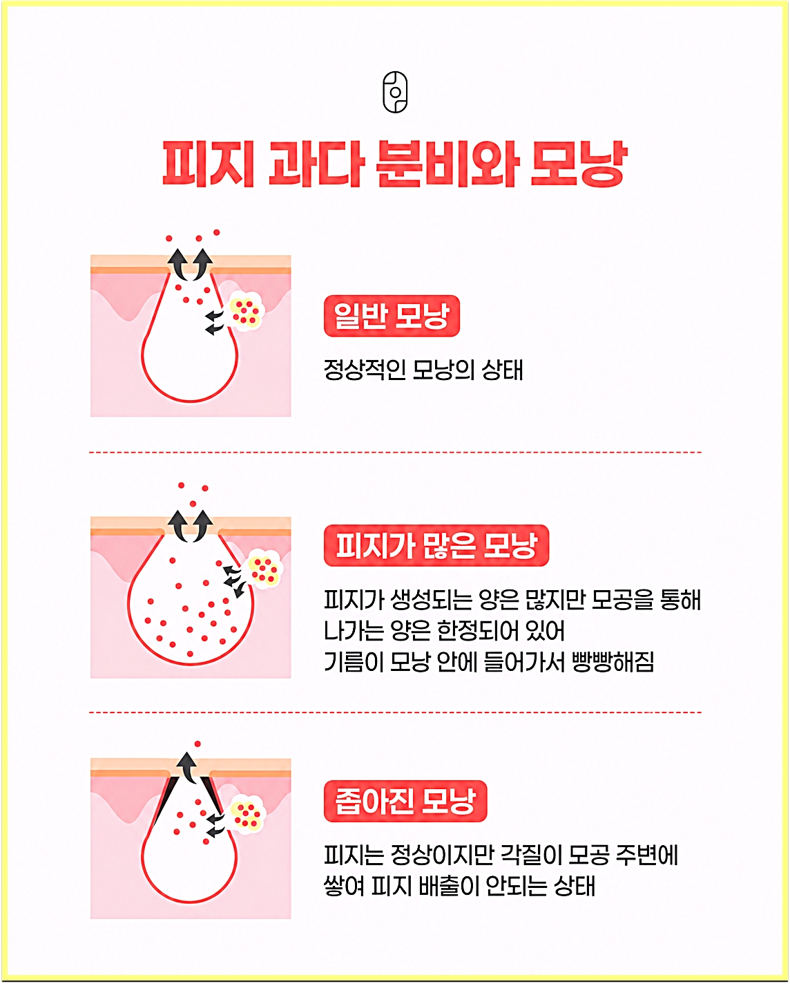 신사여드름한의원 후한의원 강남점 피지 과다 분비와 모낭 상태 비교