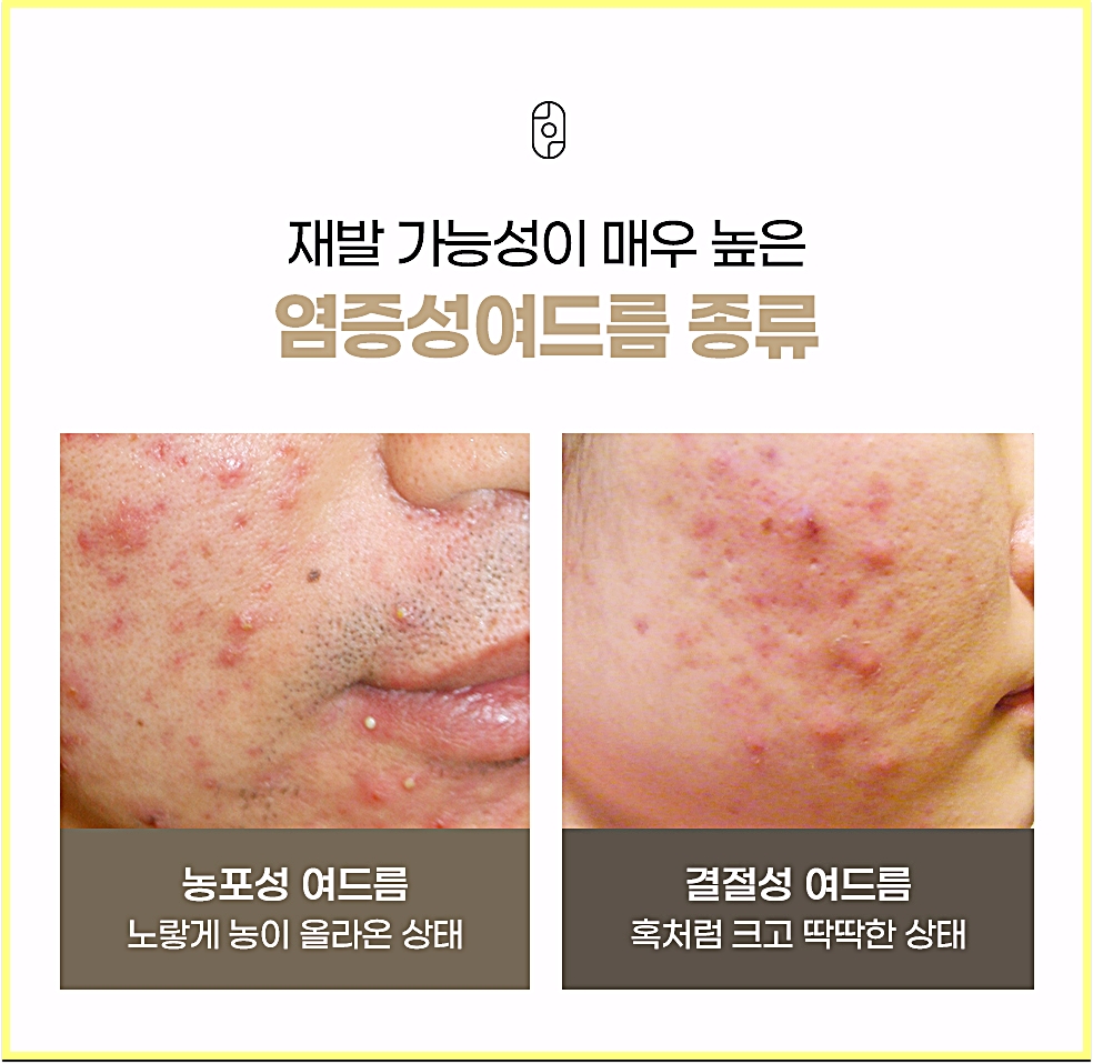 신사여드름한의원 후한의원 강남점 염증성 여드름 종류 농포성 여드름과 결절성 여드름