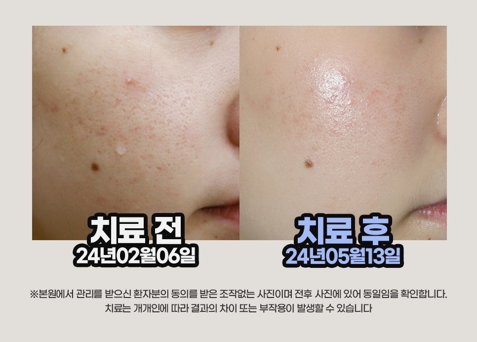 강남점에서 진행한 여드름흉터 치료 전후