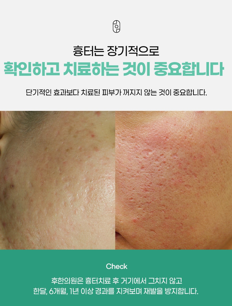 단기 효과보다 치료된 피부가 꺼지지 않는지 한 달, 6개월, 1년 이상 지켜보며 재발을 막는 흉터 경과 관리 안내