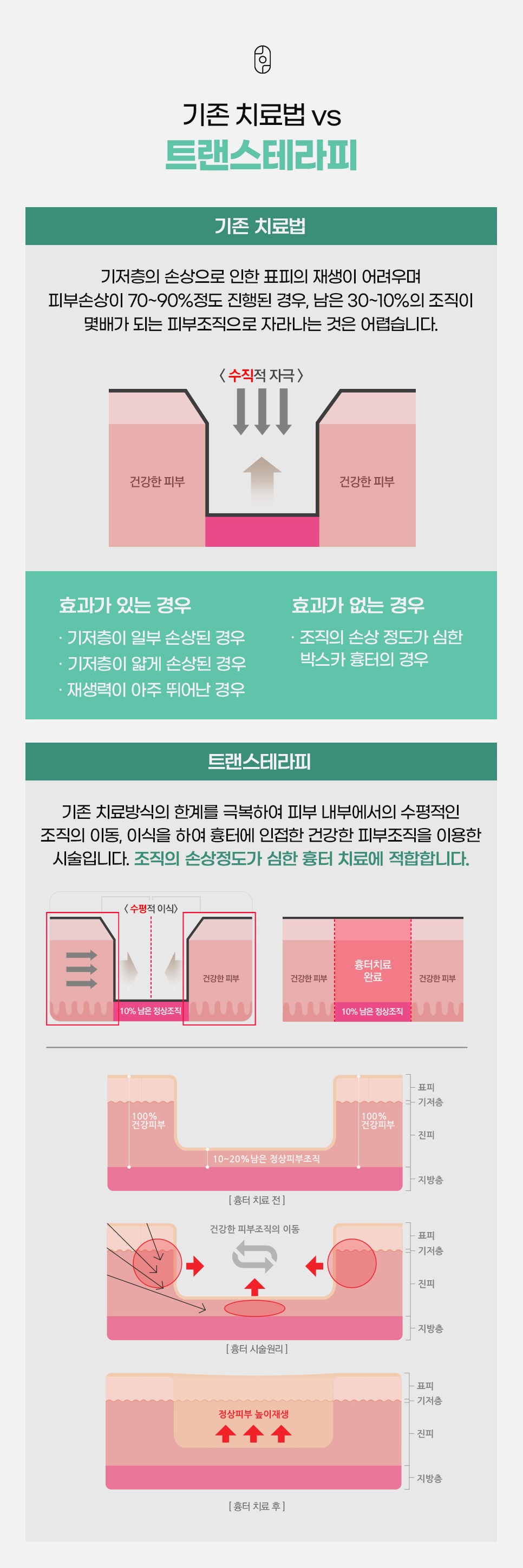 수직 자극에 그치는 기존 치료법과 건강한 피부조직을 수평으로 이식해 깊은 흉터를 채우는 트랜스테라피 비교