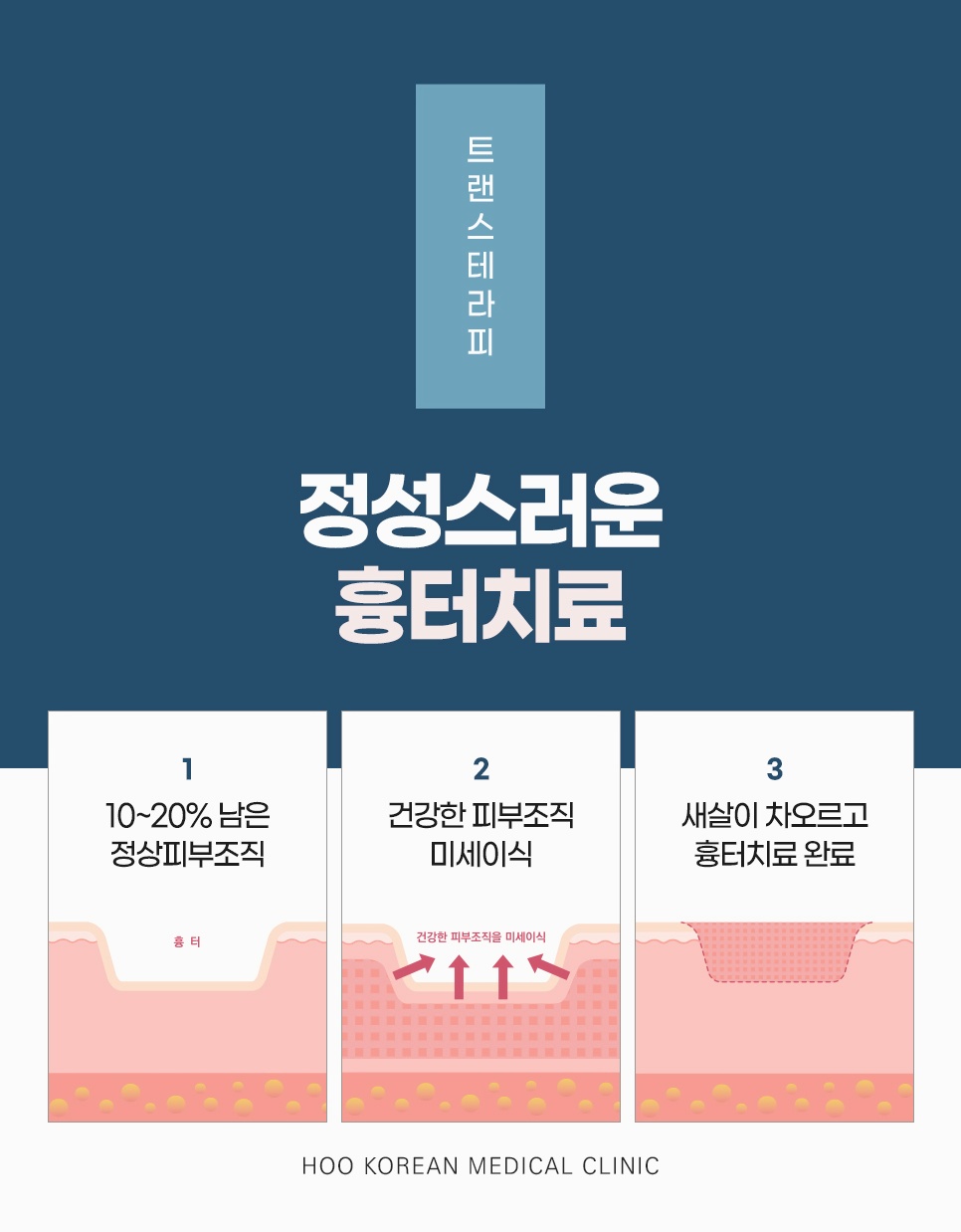 강남얼굴흉터치료 트랜스테라피 3단계