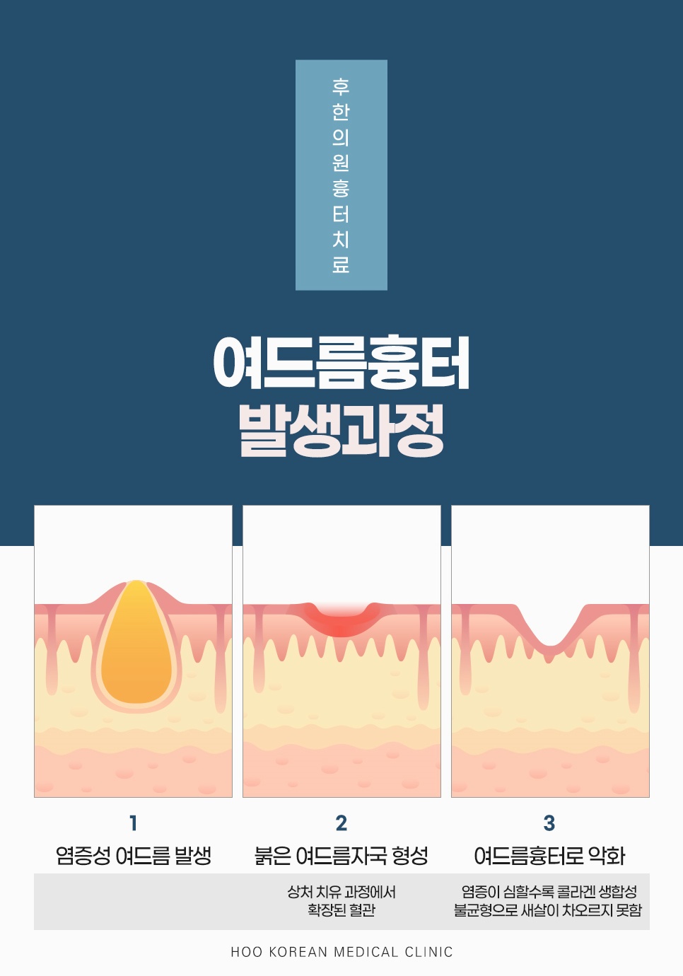 강남얼굴흉터치료 흉터 발생과정 3단계