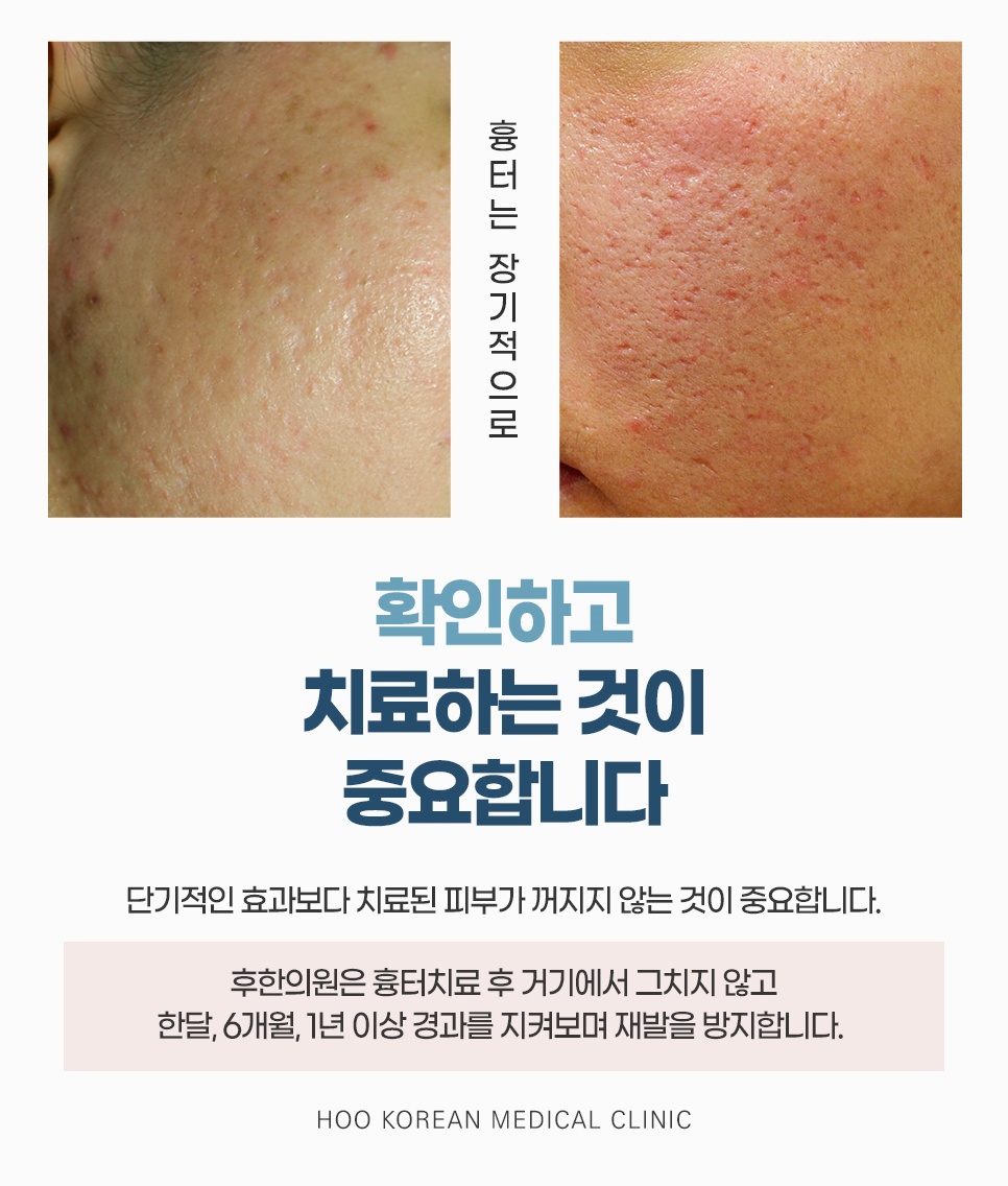 얼굴흉터치료 후 장기 경과 관리